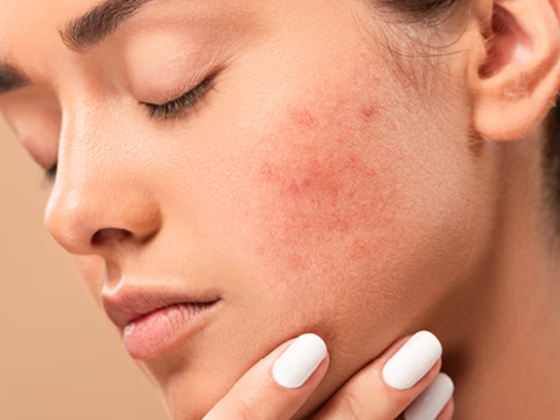 Dấu hiệu nhận biết làn da mỏng yếu, nhạy cảm