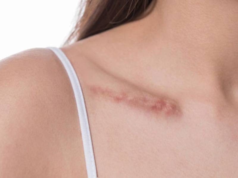 Dấu hiệu nhận biết sẹo phì đại