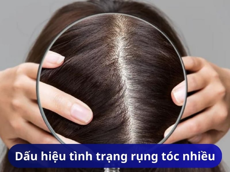 Dấu hiệu tình trạng rụng tóc nhiều