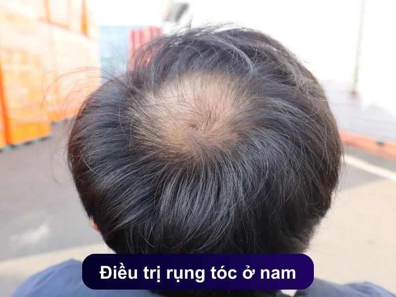 Điều trị rụng tóc ở nam