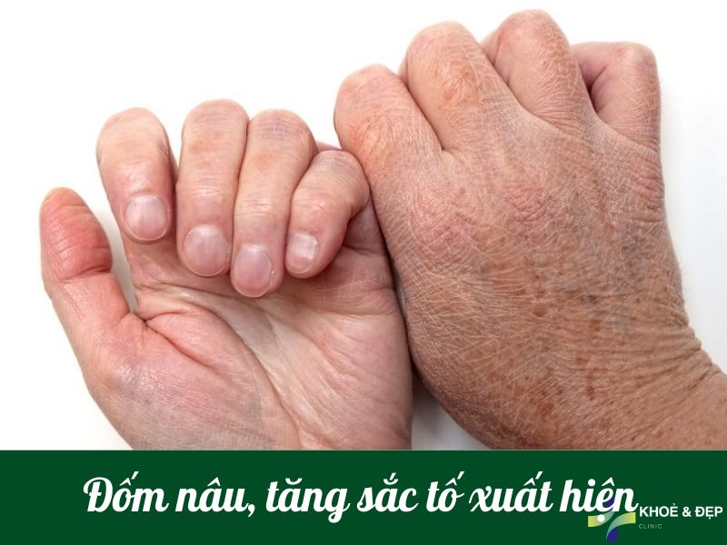 Đốm nâu, gia tăng sắc tố