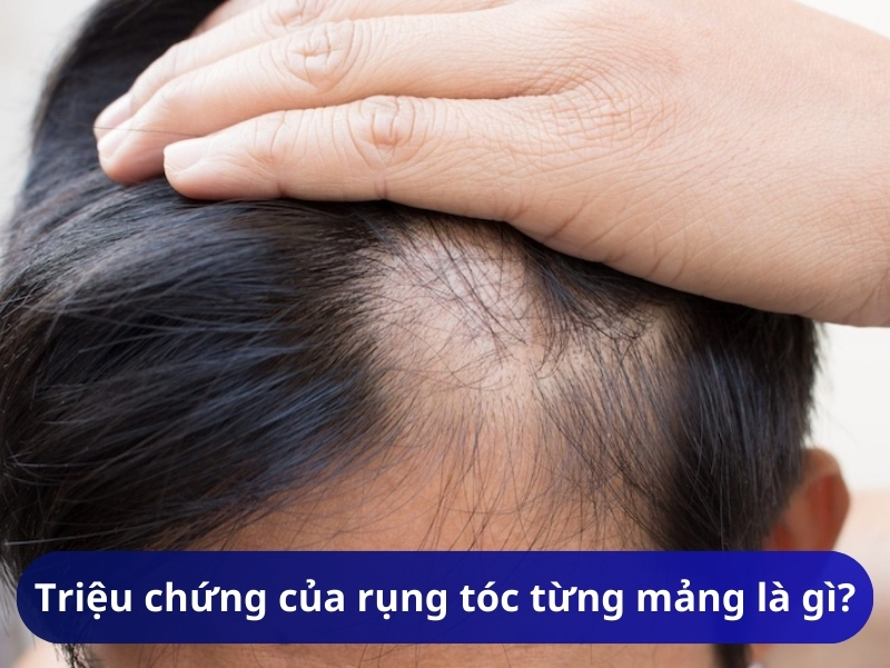 Triệu chứng của rụng tóc từng mảng là gì?