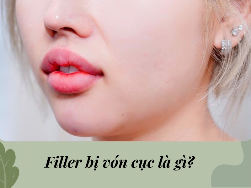 Filler bị vón cục là gì?