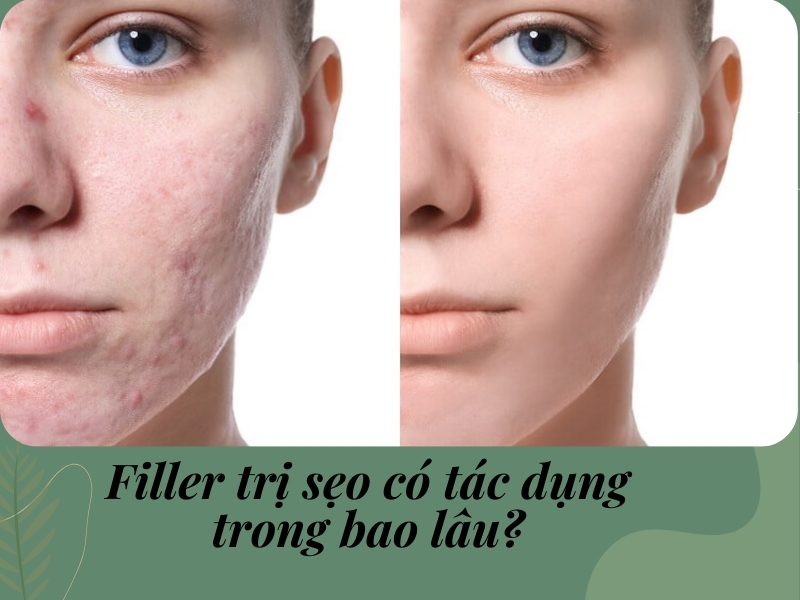 Filler trị sẹo có tác dụng trong bao lâu?
