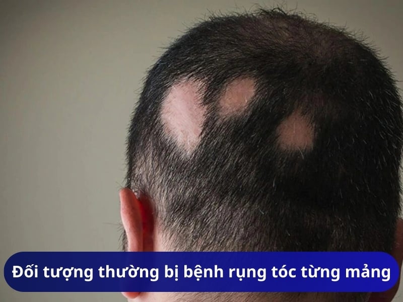 Đối tượng thường bị bệnh rụng tóc từng mảng tròn