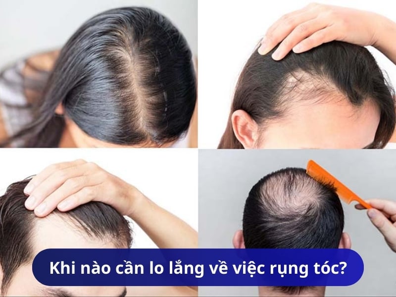 Khi nào cần lo lắng về việc rụng tóc?