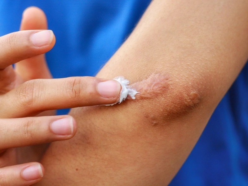 Khi nào nên dùng thuốc trị sẹo?