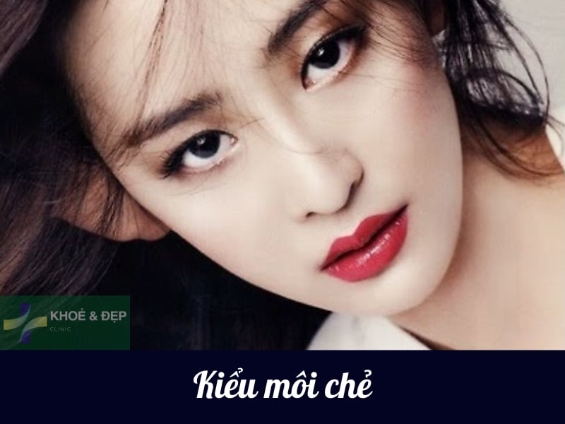 Kiểu tiêm filler môi chẻ