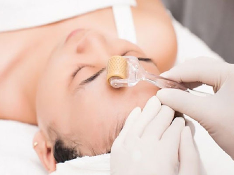 Lăn kim điều trị sẹo rỗ là gì?