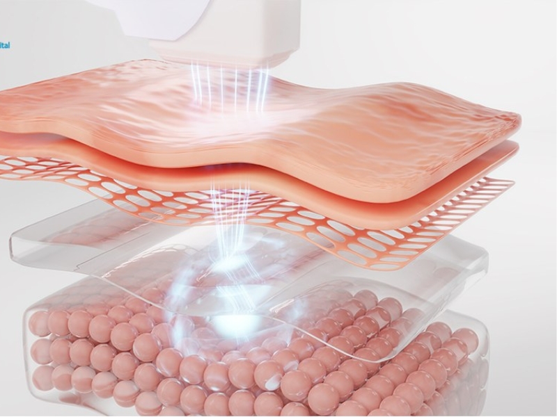 Laser tái tạo da là gì?