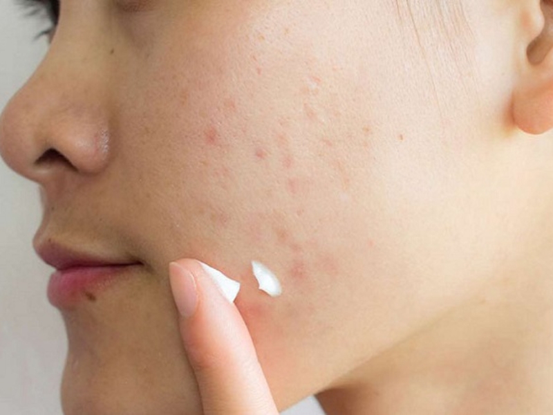 Một số lưu ý khi sử dụng thuốc trị sẹo thâm