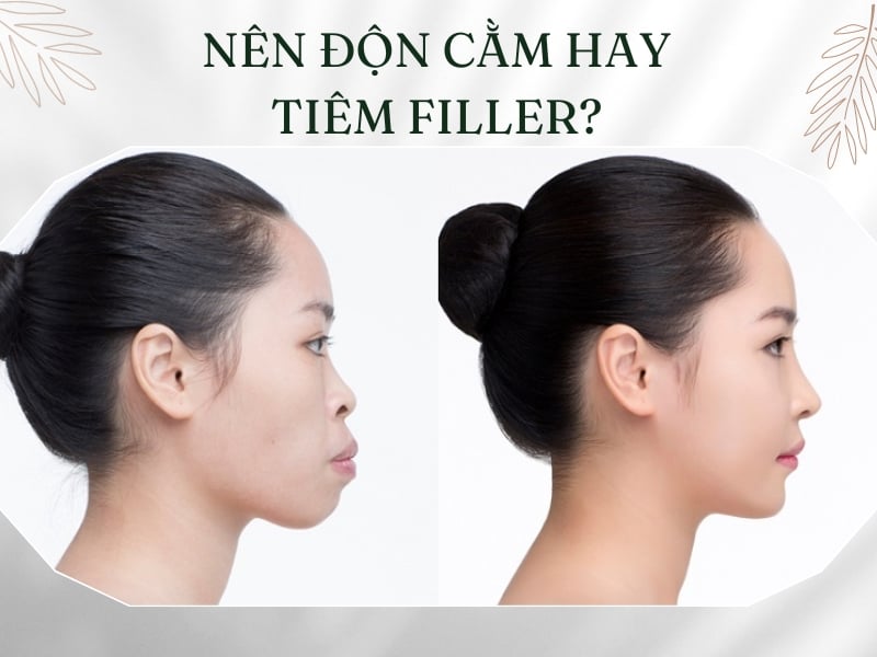 Nên độn cằm hay tiêm filler?