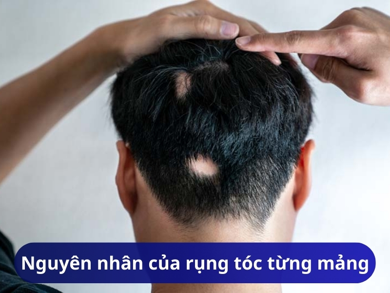 Nguyên nhân của rụng tóc từng mảng