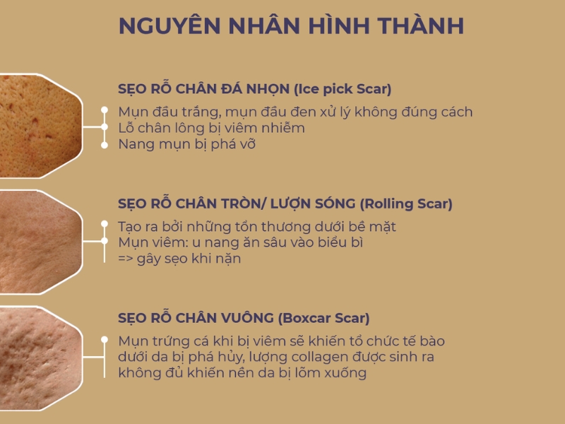 Nguyên nhân hình thành sẹo lõm