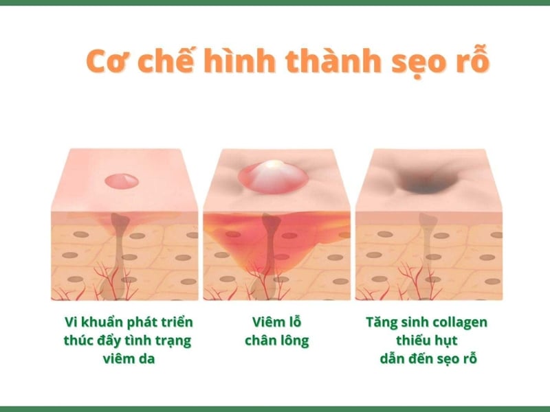 Nguyên nhân hình thành sẹo rỗ