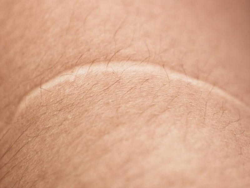 Nguyên nhân hình thành sẹo trắng trên da