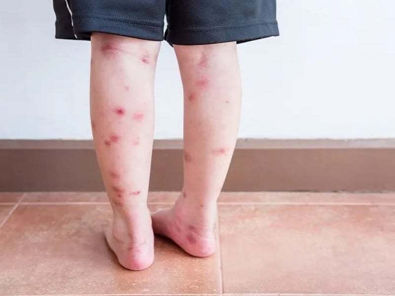 Nguyên nhân khiến chân bị sẹo, thâm