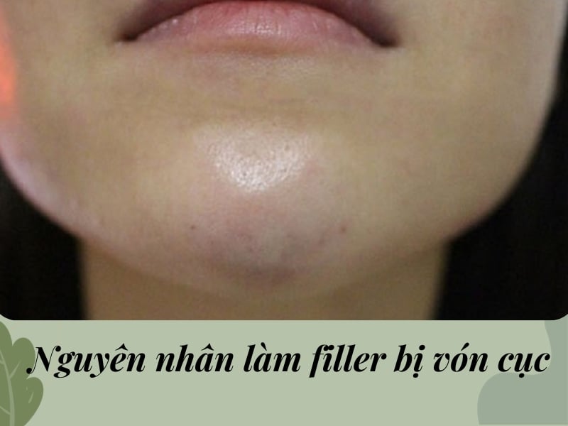 Nguyên nhân làm filler bị vón cục
