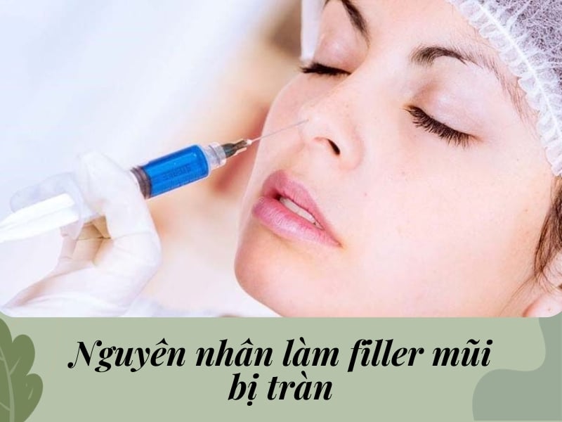 Nguyên nhân làm filler mũi bị tràn