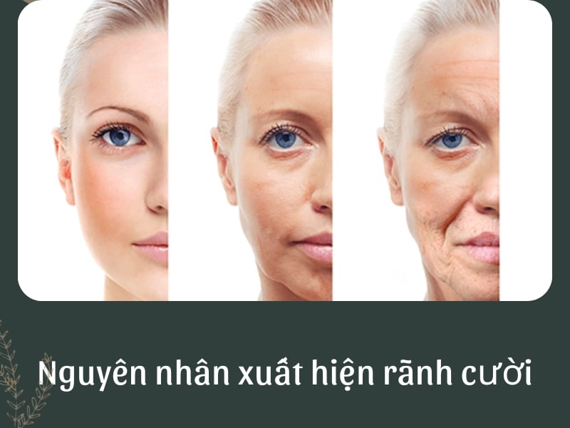 Nguyên nhân xuất hiện rãnh cười