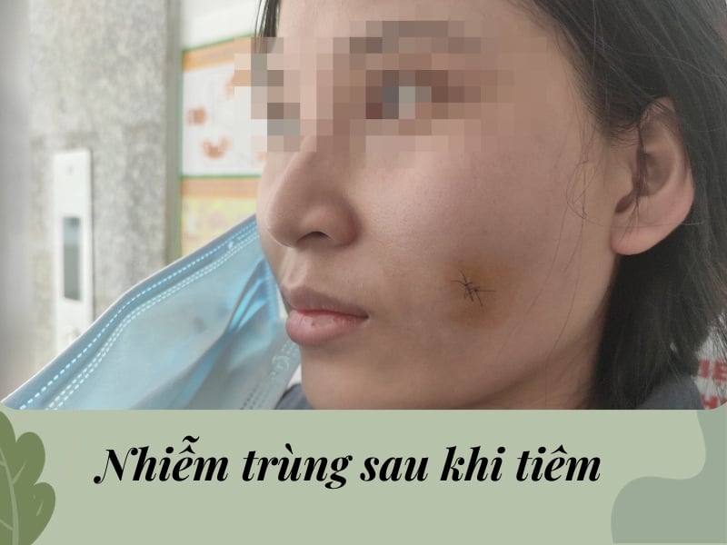 Nhiễm trùng sau khi tiêm