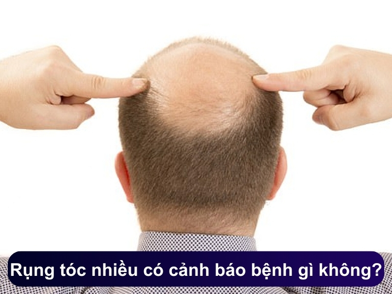 Rụng tóc nhiều ở nam có cảnh báo bệnh gì không?