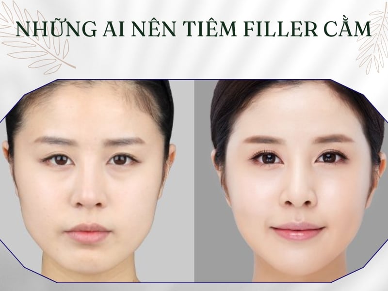 Những ai nên tiêm filler cằm?