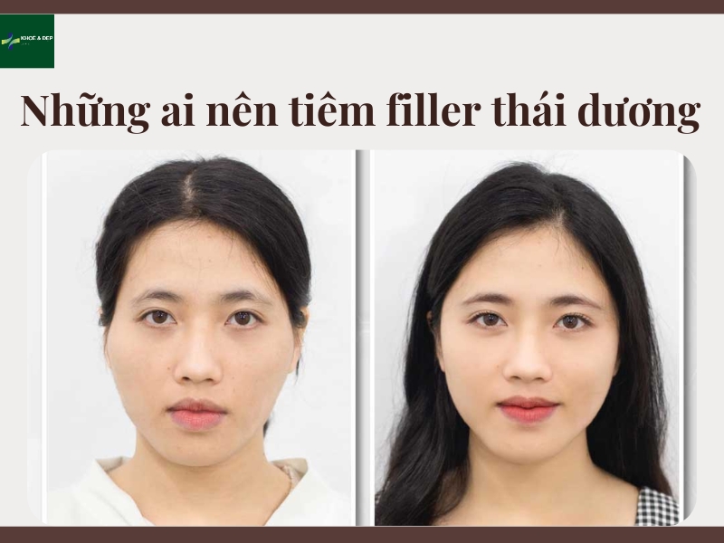 Những ai nên tiêm filler thái dương