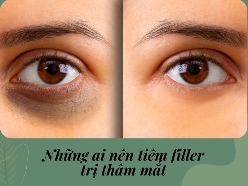 Những ai nên tiêm filler trị thâm mắt