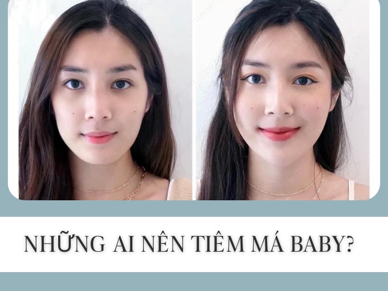Những ai cần tiêm filler má baby?