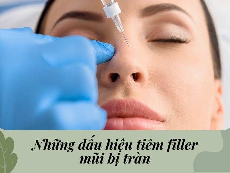 Những dấu hiệu của tiêm filler mũi bị tràn