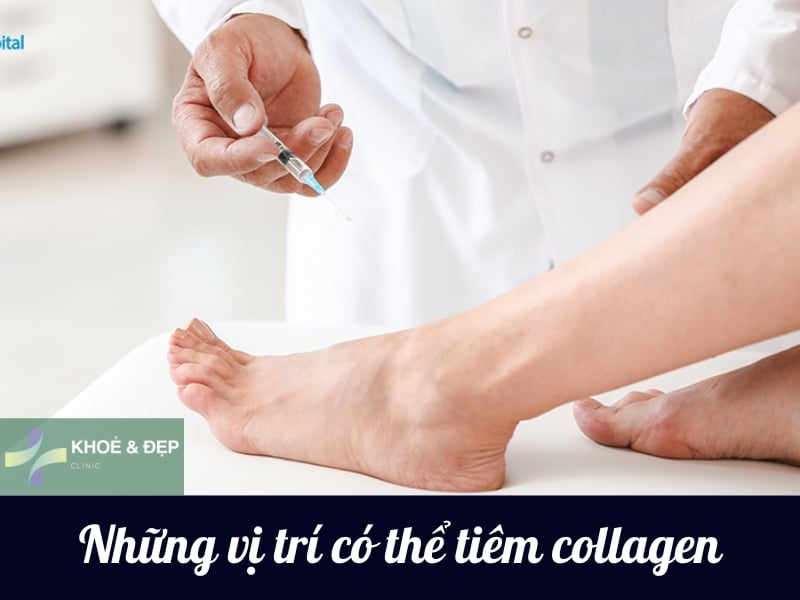 Các vị trí trên cơ thể có thể bổ sung collagen trực tiếp