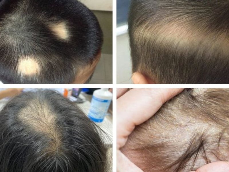 Phân loại các loại rụng tóc ở trẻ em 6 tuổi