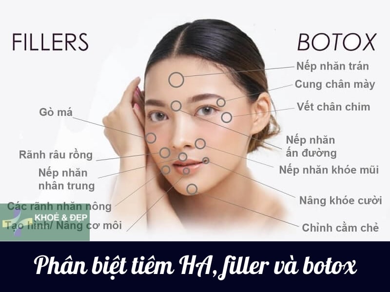 So sánh sự khác biệt giữa Hyaluronic Acid, filler và botox