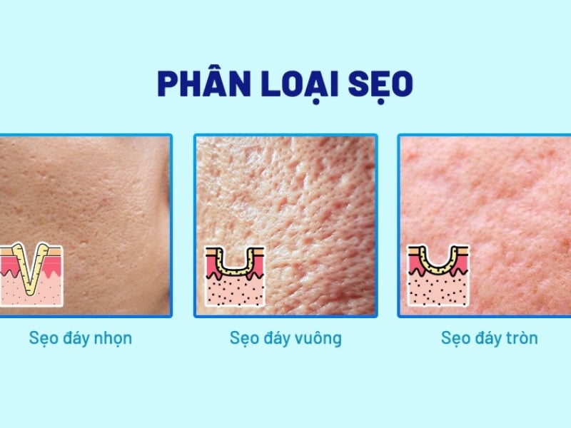 Phân loại các loại sẹo rỗ thường gặp