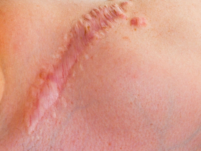 Phòng ngừa sẹo lồi sau điều trị như thế nào?