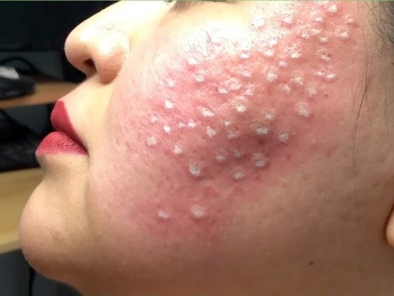 Phương pháp tái tạo da bằng TCA chấm sẹo