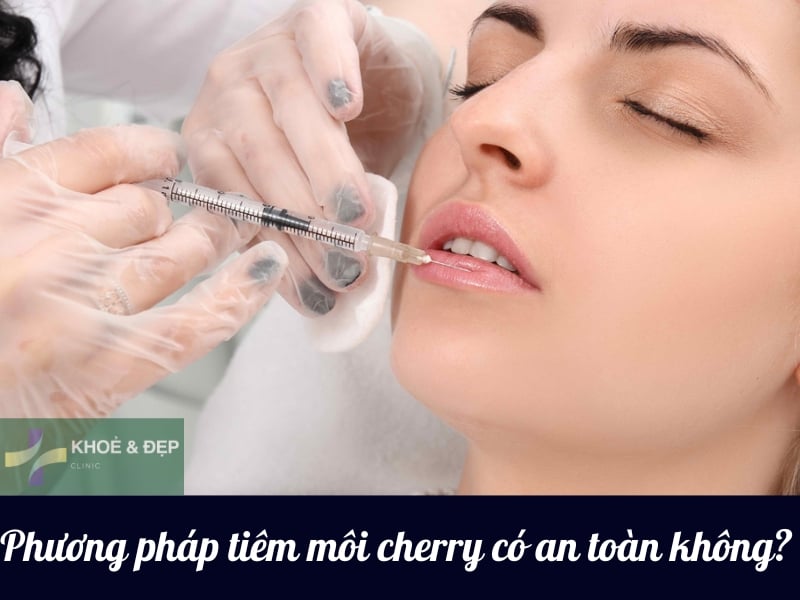 Tiêm filler môi cherry có an toàn hay không?