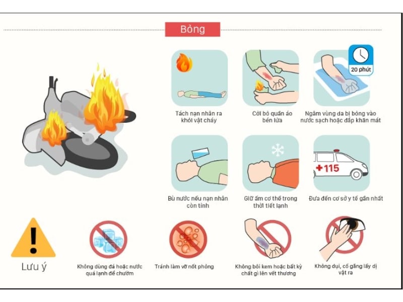 Quy trình chung khi sơ cứu vết bỏng