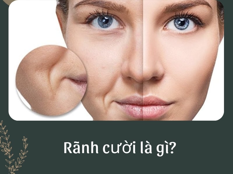 Rãnh cười là gì?