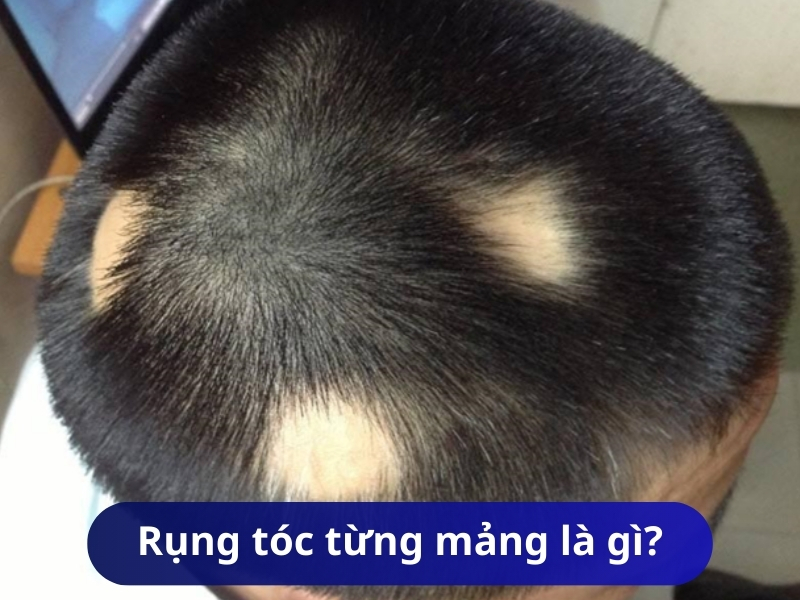 Rụng tóc từng mảng là gì?