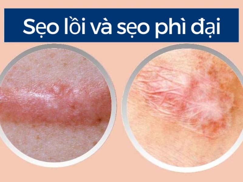 Sẹo lồi và sẹo phì đại có gì khác nhau