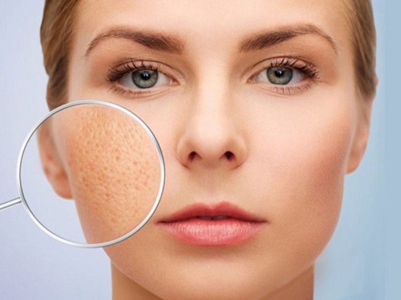 Sẹo lõm có hại không? Có gây ảnh hưởng gì không?