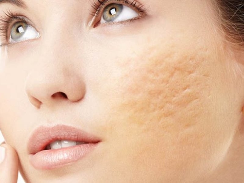 Sẹo lõm có khó điều trị không?