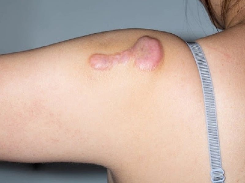 Sẹo phì đại bao lâu thì khỏi?