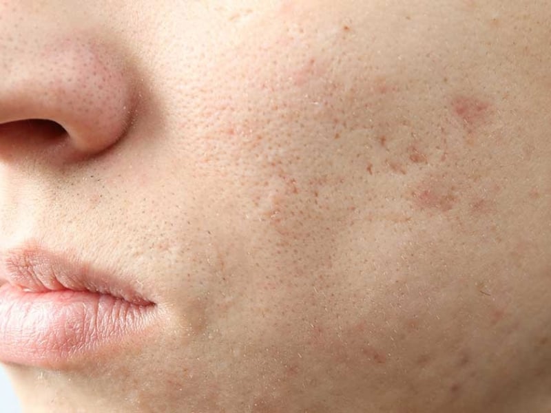 Sẹo rỗ có trị được không?