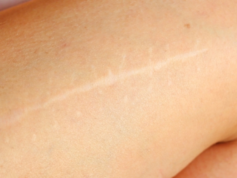 Sẹo trắng là gì?