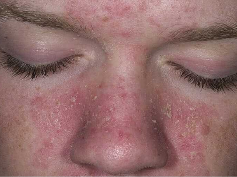 Tác hại của rượu thuốc trị mụn