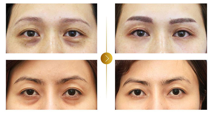 Tiêm HA cho mắt có có công dụng gì?