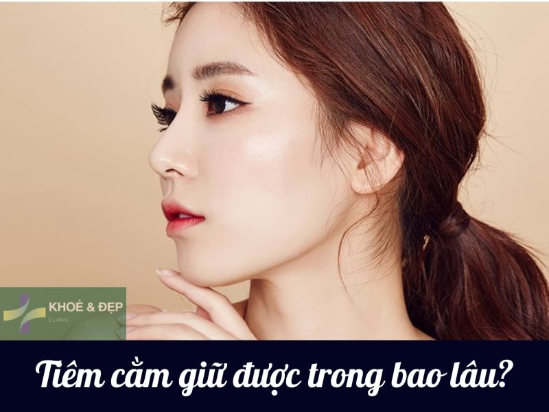 Tiêm cằm V-line giữ được trong bao lâu?